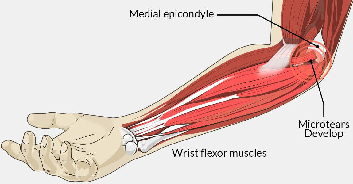  Medial epicondylitis (golfer's elbow) anatomy. 