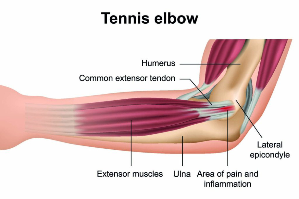  Lateral epicondylitis (tennis elbow) anatomy. 